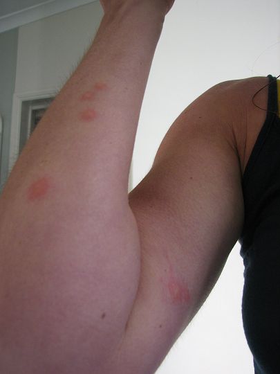 IMG_8201.JPG - Ooouch. sand-fly bites get ugly.